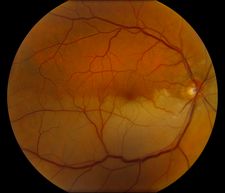 branch-retinal-artery-occlusion