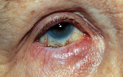 Enfermedades de párpados - Ocularis