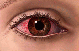 Migración baños genio Complicaciones de las lentes de contacto - Ocularis