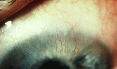 Caliza exposición esta ahí Complicaciones de las lentes de contacto - Ocularis