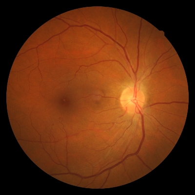 La retinopatía hipertensiva - Ocularis